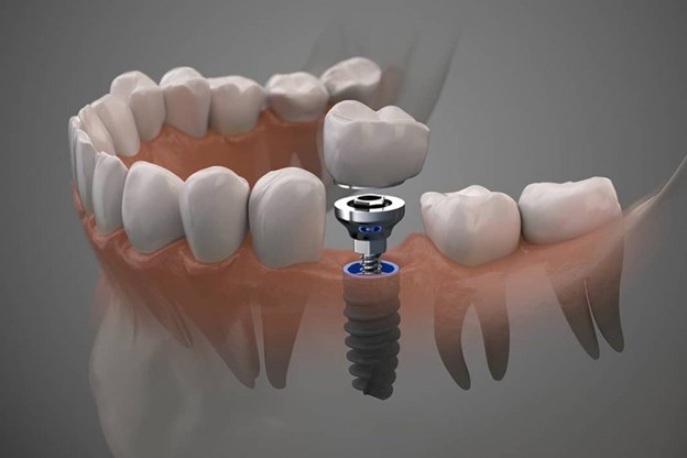 تکنیک های جدید در ایمپلنت دندان