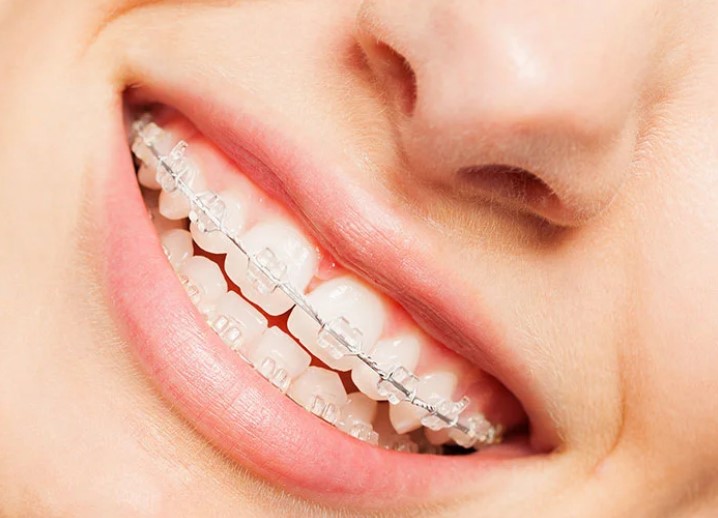 برای زیبایی دندان‌ها به ترتیب چه کارهایی انجام دهیم؟